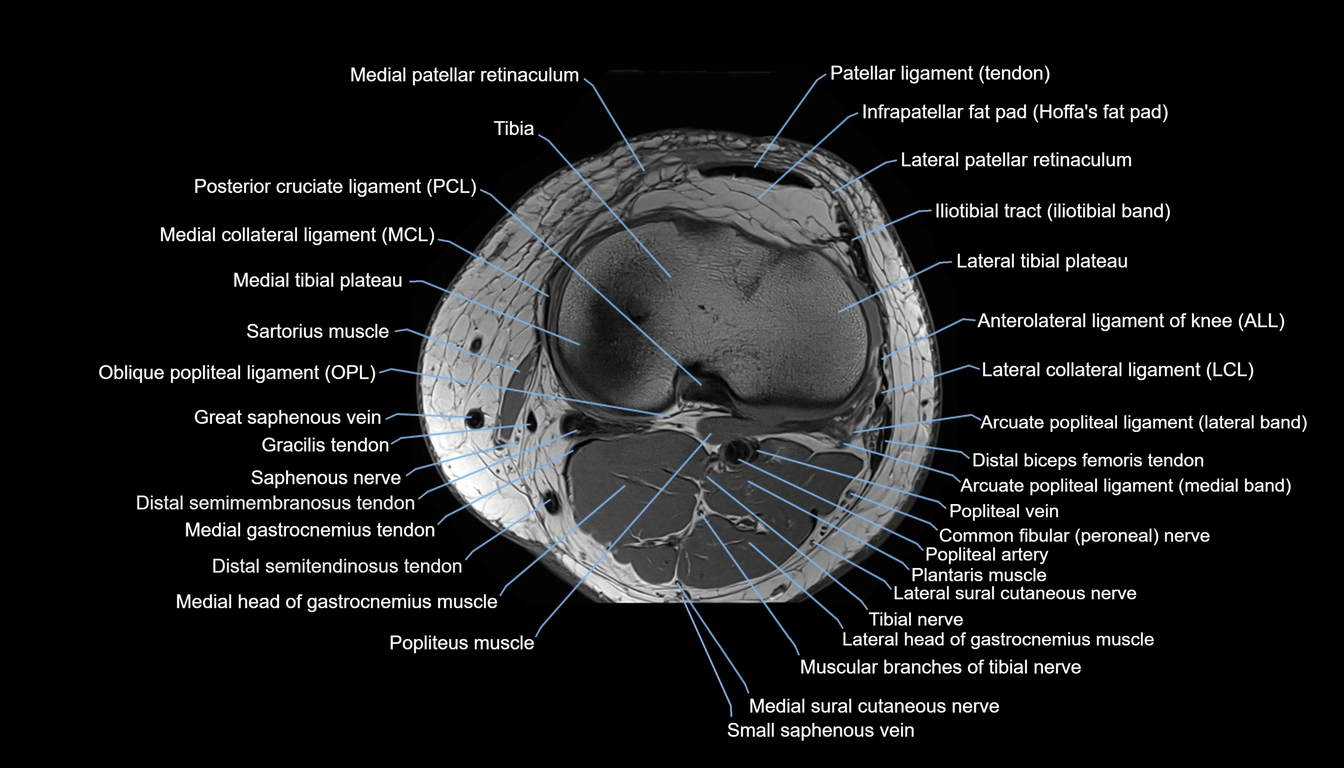 MRI knee  axial cross sectional anatomy 3T radiology  image-img-00001-00032.webp